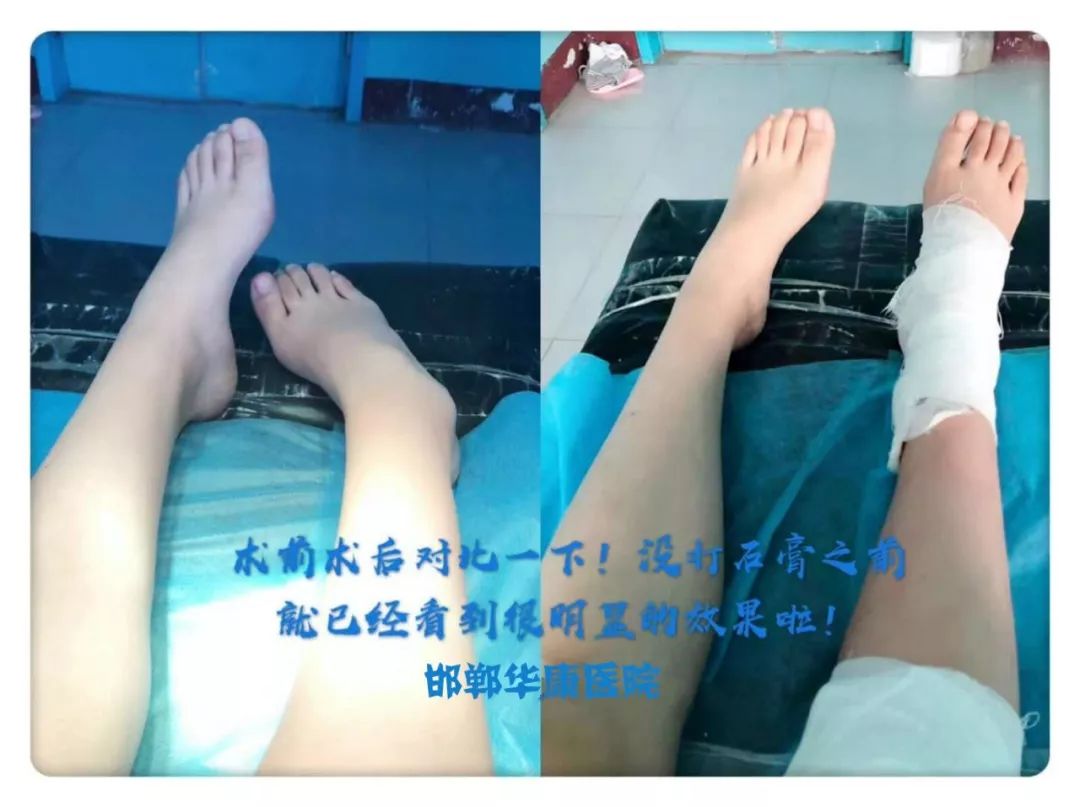 髖關節訓練器的適應癥_髖關節訓練椅_髖關節訓練器