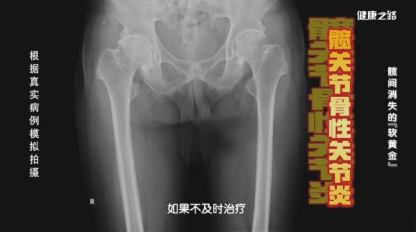 開yun體育官網入口登錄app 你的髖關節還好嗎？3個小測試速來檢查
